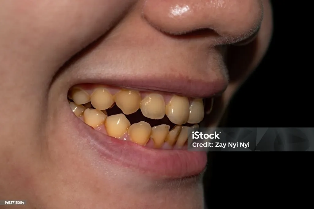 一個微笑的女人露出變黃的牙齒